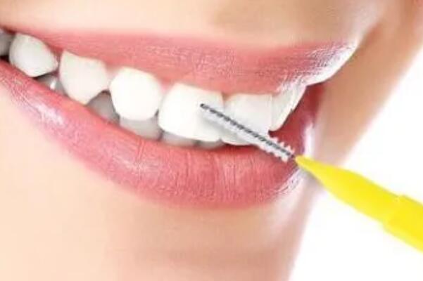 牙間縫刷的用途和作用 牙間縫刷的用途和作用